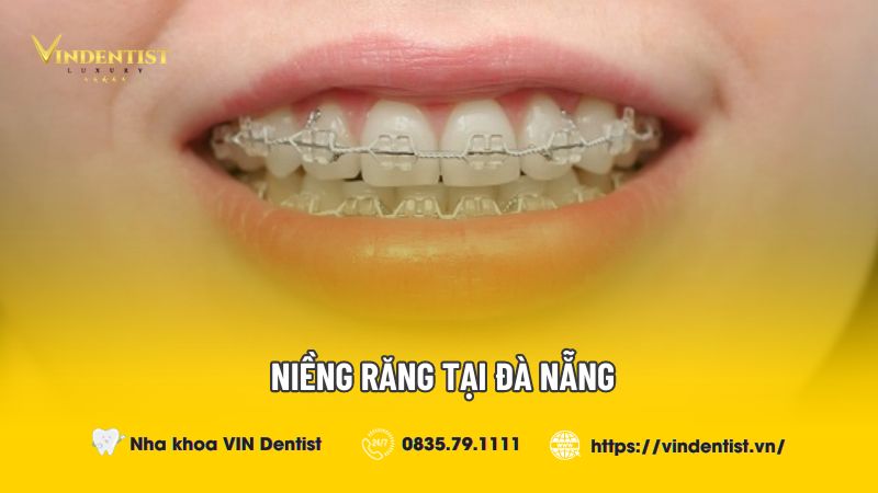Niềng răng tại Đà Nẵng ở đâu tốt?